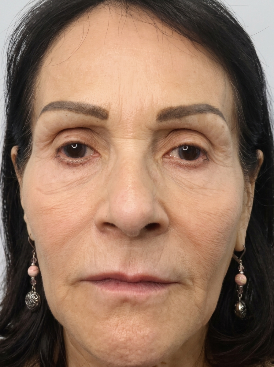 Resultado depois de usar GlowLift